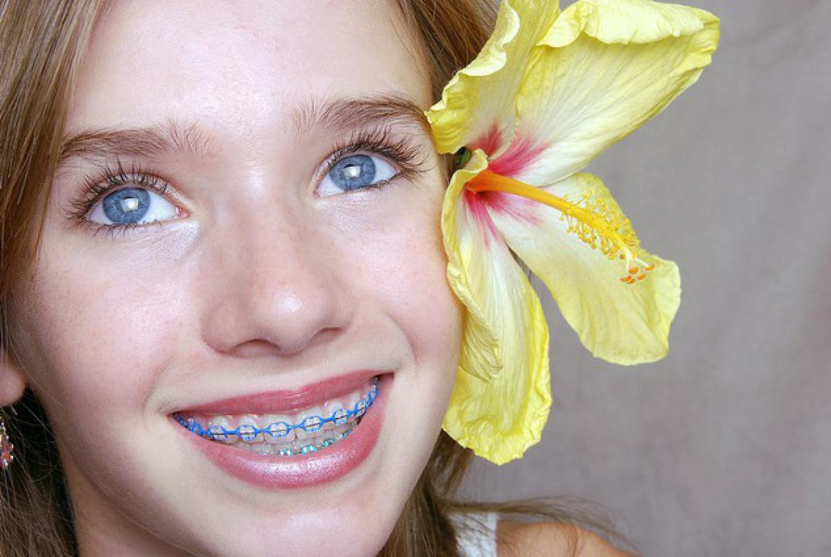 Braces For Kids Types Benefits And Prevention Of Tooth Decay Viewkick